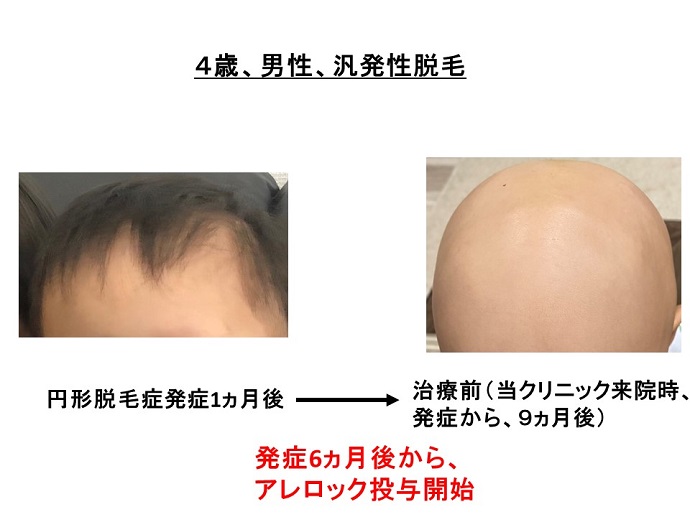 円形脱毛症　病院